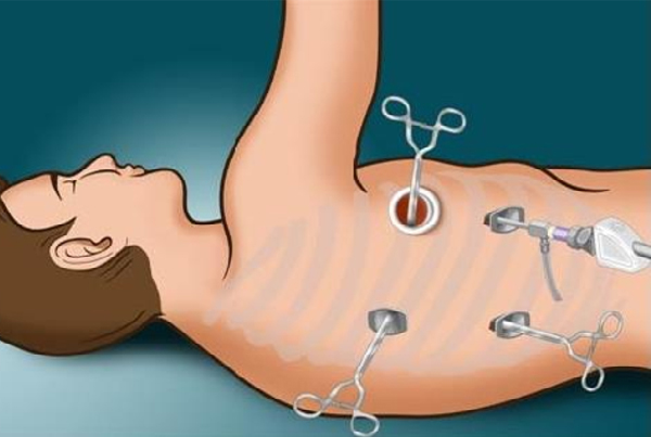 Thoracoscopy