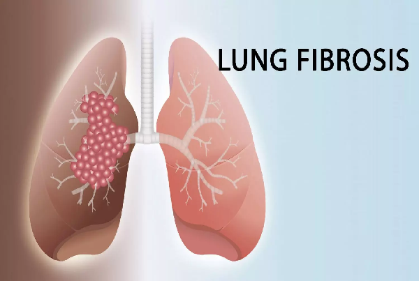 Lung Fibrosis