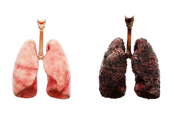 Lung Cancer