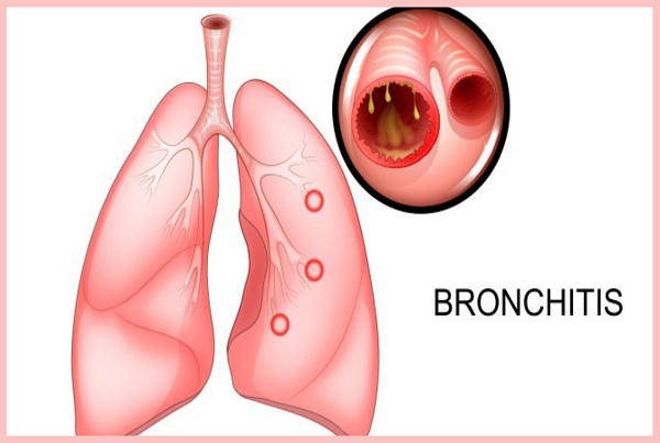 Bronchitis