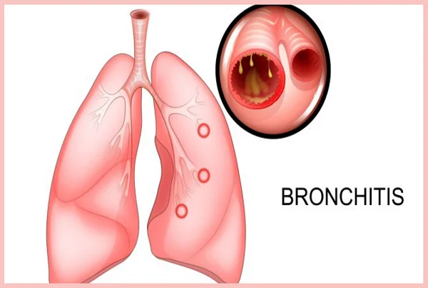 Bronchitis
