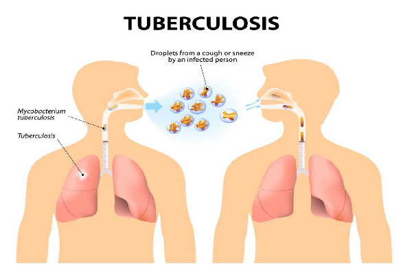 Tuberculosis