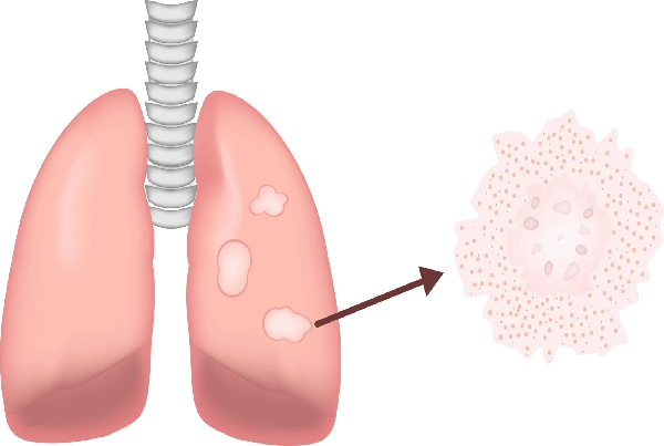 Sarcoidosis