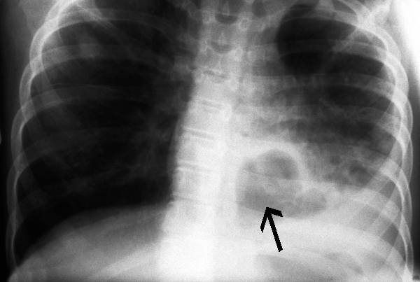 Lung Abscess