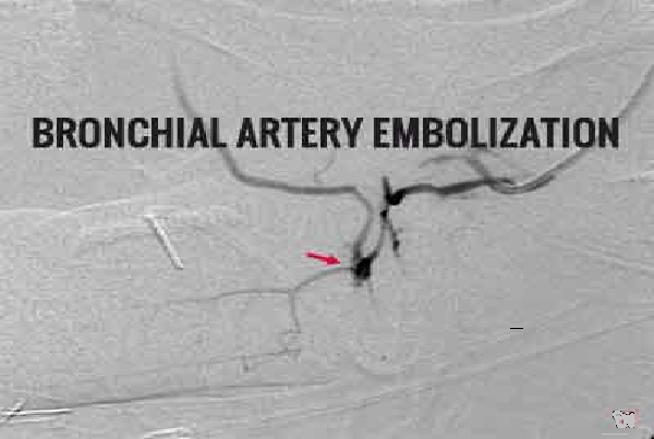 Pulmonary Artery Embolisation