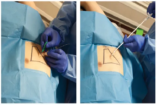 Pigtail catheter Insertion